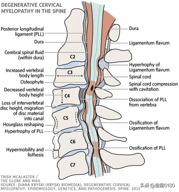 怎么才知道颈椎病发作,颈椎病怎么知道是不是急性的