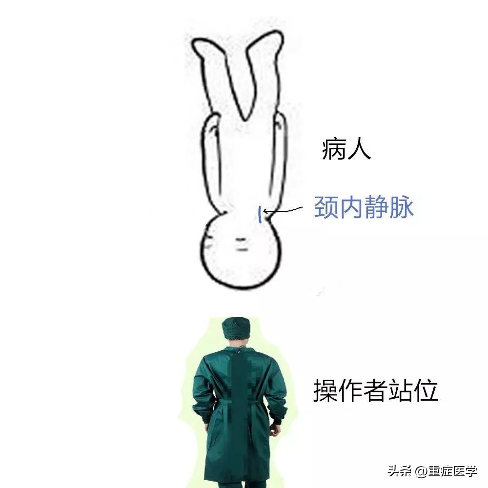 保姆级深静脉穿刺全攻略，建议收藏！