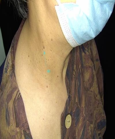 脖子上长个小肉揪怎么弄掉,脖子上长了一个小肉粒被揪下来