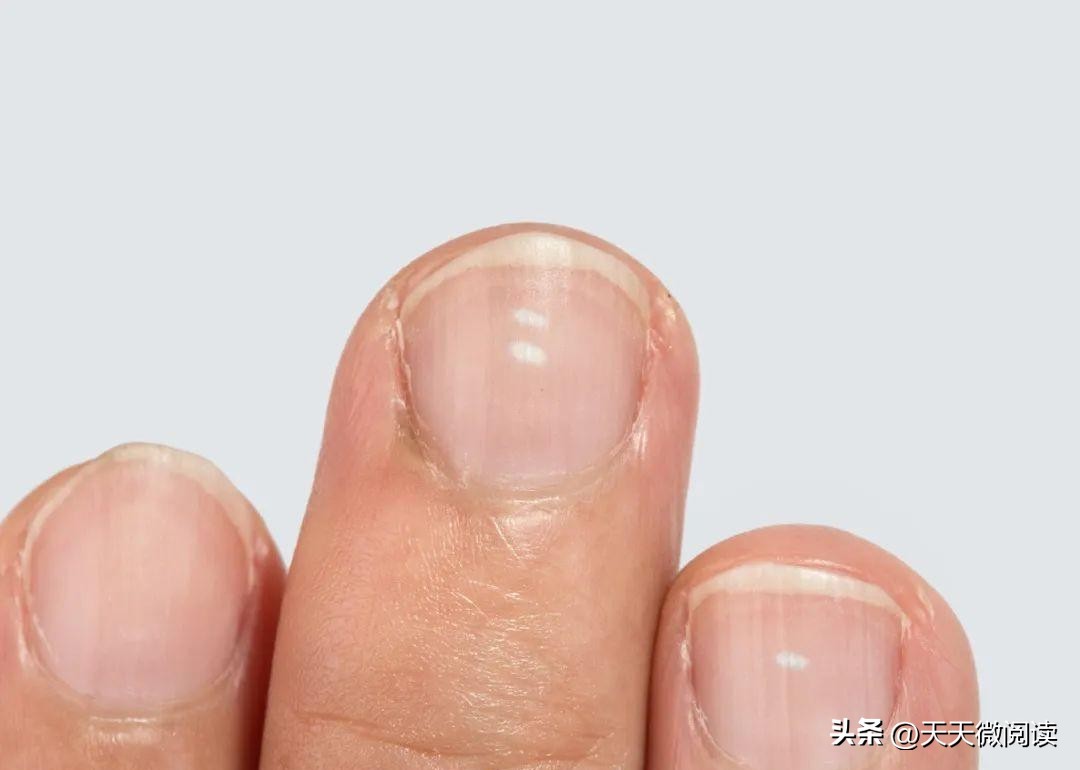 大拇指甲上有白色竖纹是怎么回事,左手大拇指指甲有黑竖纹怎么回事