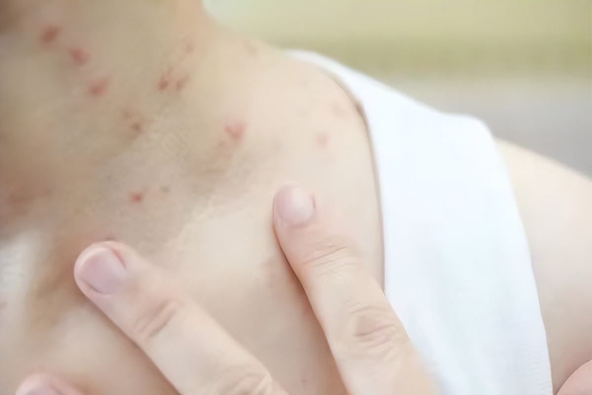 宝宝过敏起荨麻疹要不要挂急诊,宝宝得了荨麻疹需要忌口吗