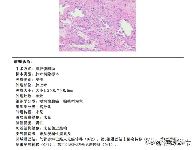 肺多发结节切除一个剩下的怎么办,无限纠结的肺小结节