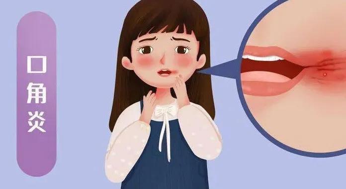 口角炎联合用药方案​