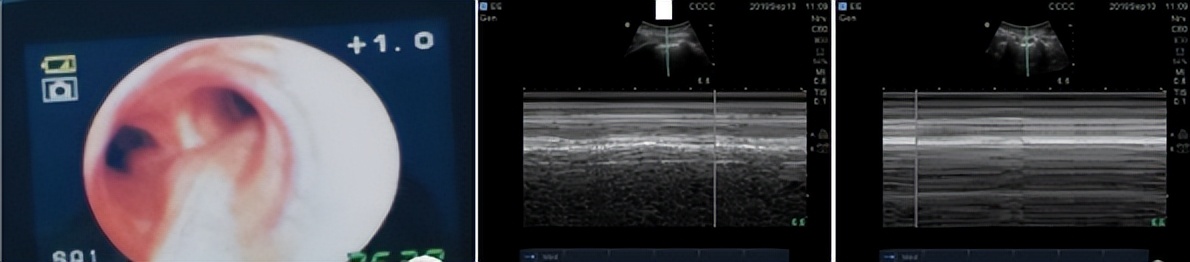 麻醉期间气道梗阻,手术后呼吸急促是什么原因