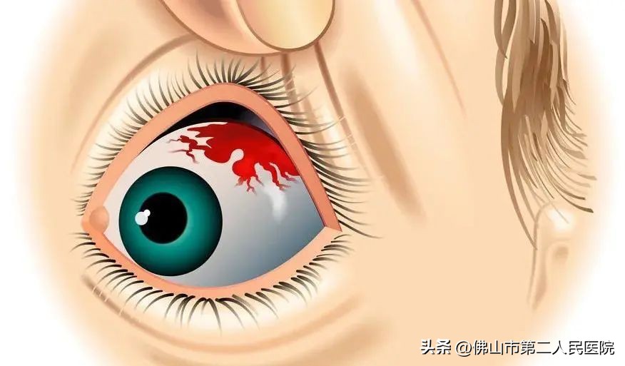 熬夜醒来眼圈红是什么原因,熬夜醒来眼睛有血丝