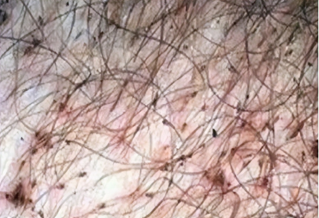 阴虱到底是什么原因引起的,什么是阴虱阴虱是怎么得的