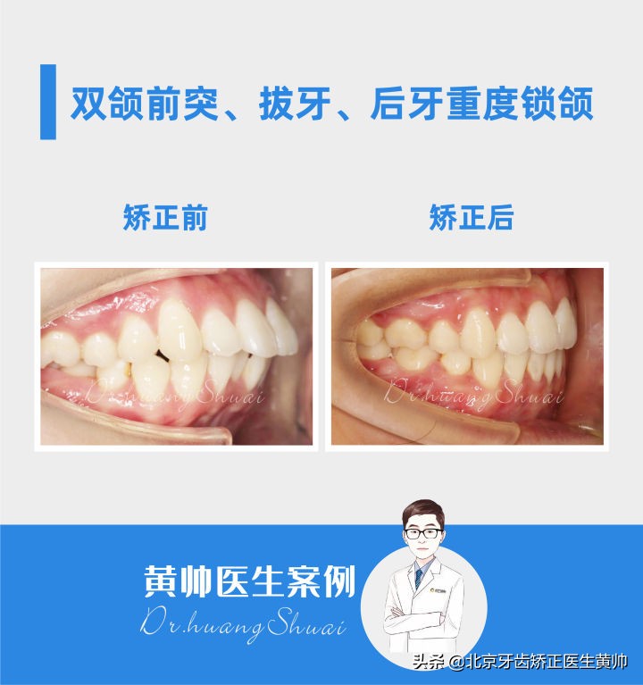 嘴凸的人怎么笑起来好看,嘴凸怎么让自己不焦虑