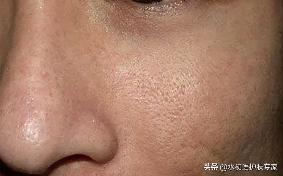 暗沉起皮毛孔大用什么护肤,皮肤油毛孔粗大暗黄用什么护肤品