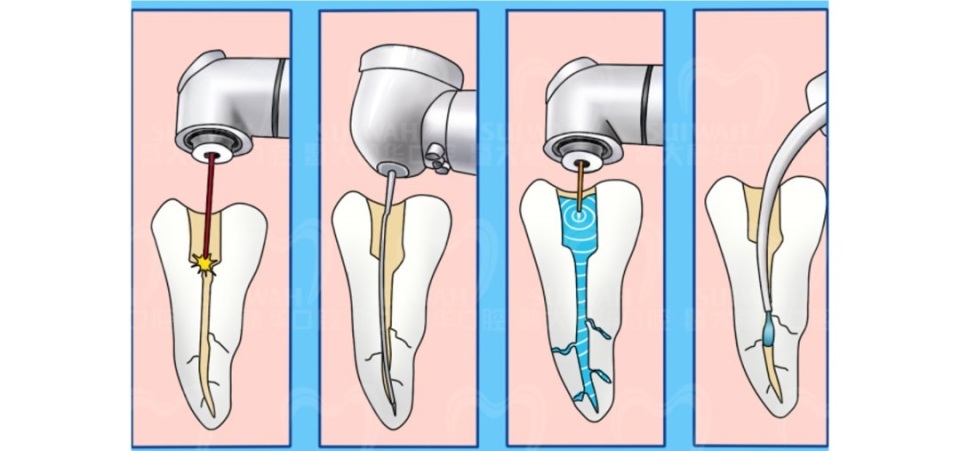 根管治疗后不戴牙套后坏掉了,根管治疗后不戴牙冠的后果
