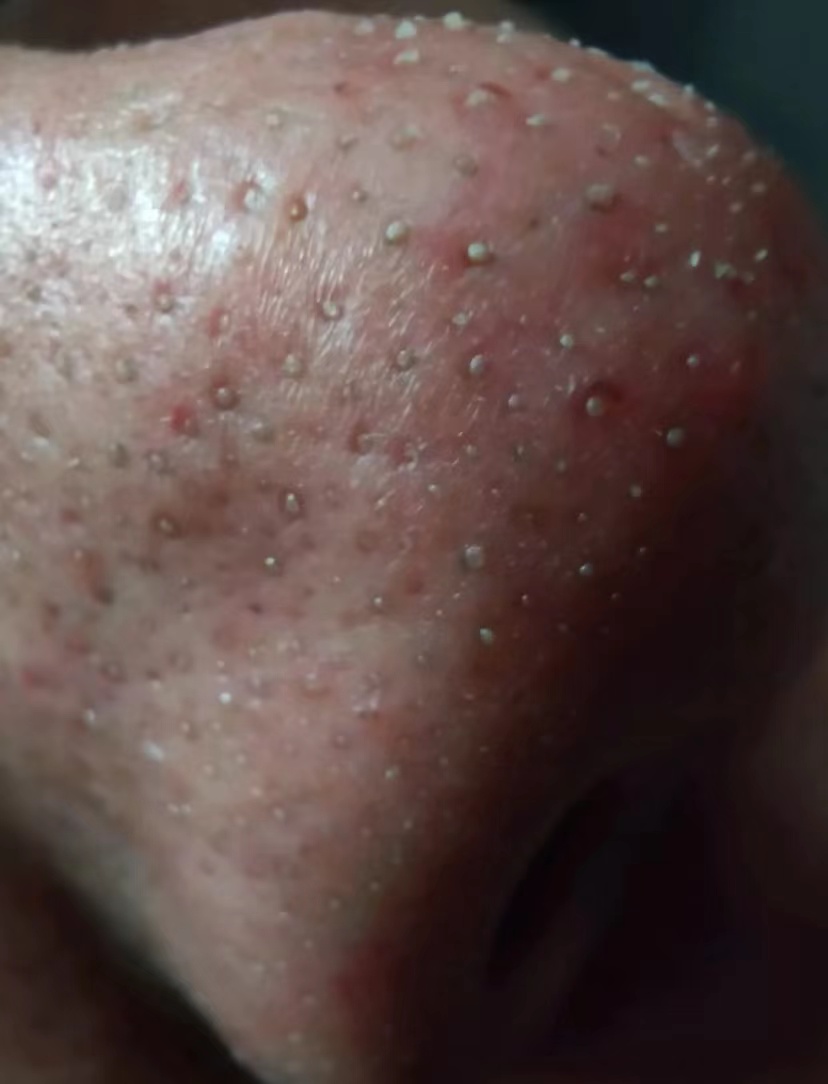 鼻子毛孔小黑头出不来怎么办,小女孩鼻子有黑头毛孔粗怎么办