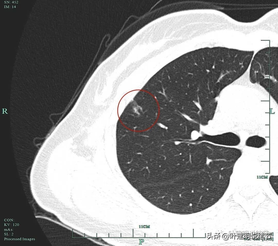 磨玻璃结节伴有增生是癌症吗,磨玻璃结节会是别的癌转移的吗