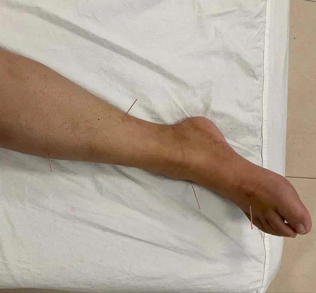 偏瘫左腿走路画圈怎样练习,偏瘫脚画圈怎么康复治疗