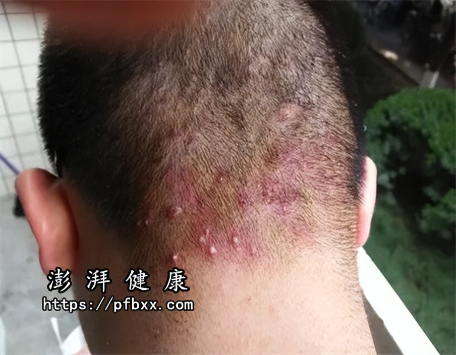 脖子上长的痘痘消下去变成硬疙瘩,脖子上痘痘挤完了有个硬疙瘩