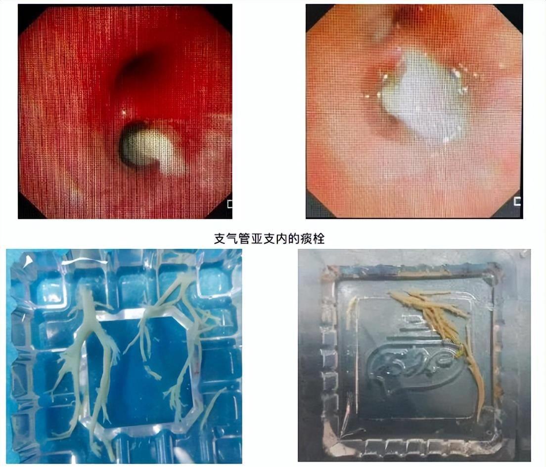 7岁男童肺部发生实变必须洗肺吗,七岁男童肺实变