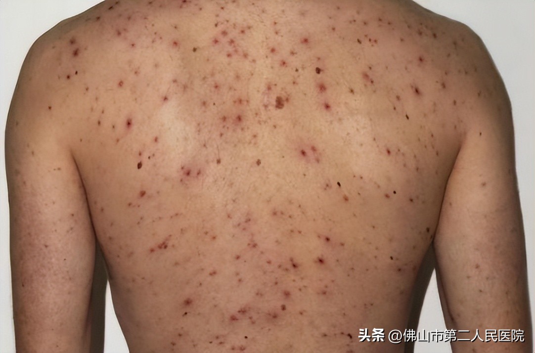 阳过之后皮疹怎么回事,阳了以后皮疹