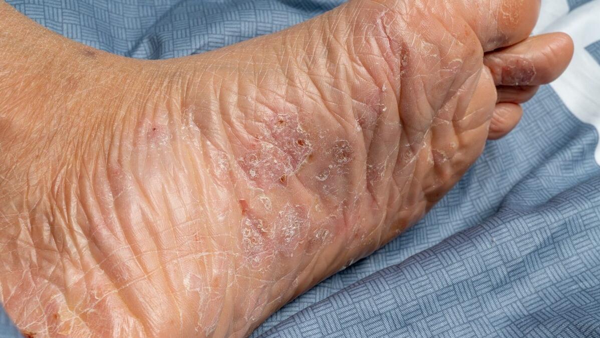 脚气很痒越挠越舒服是脚气吗,脚气越抹药膏越痒怎么回事