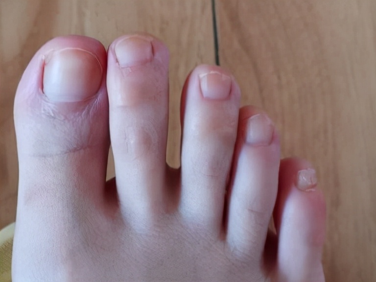 灰指甲反复处理不好根源在哪里,灰指甲治疗需要反复修理甲床吗