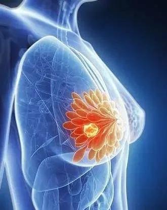 浸润性乳腺导管癌一期能治疗好吗,浸润性导管癌和小叶癌预后哪个好