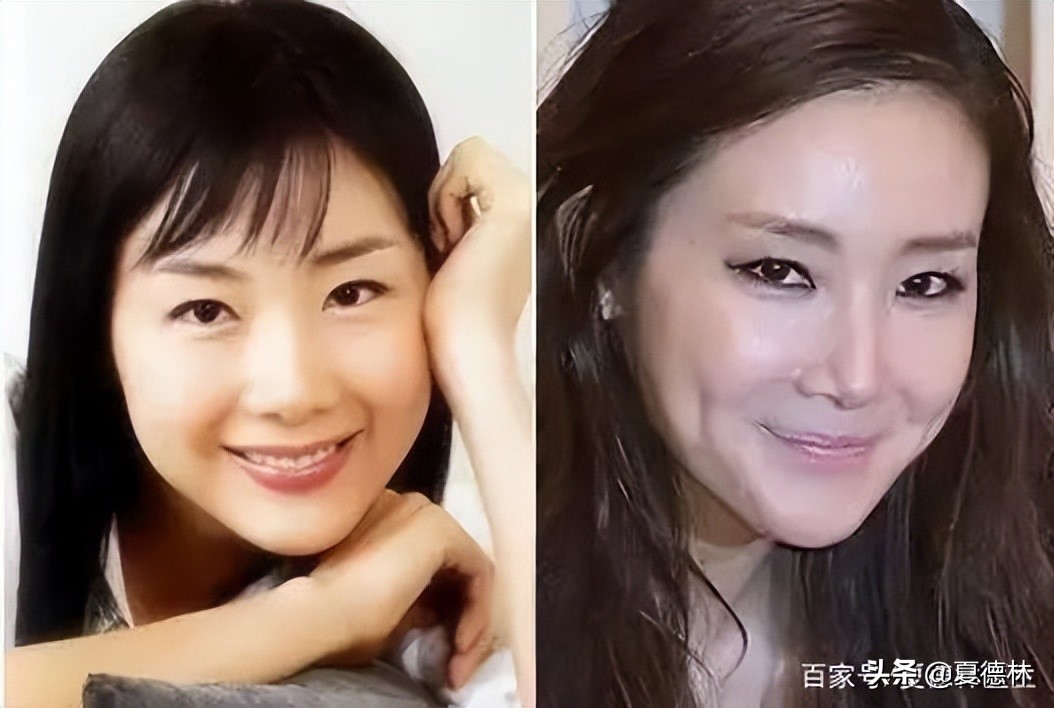 歪脸越来越严重怎么办,偏颌歪脸成人怎么改善