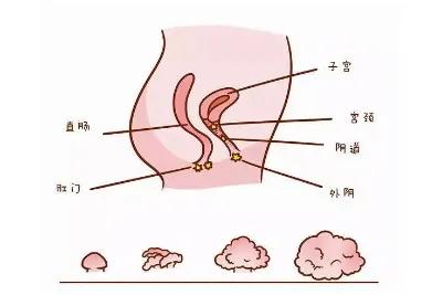 尖锐性湿疣是由哪几种hpv病毒引起,患了尖锐湿疣就一定有感染hpv病毒吗