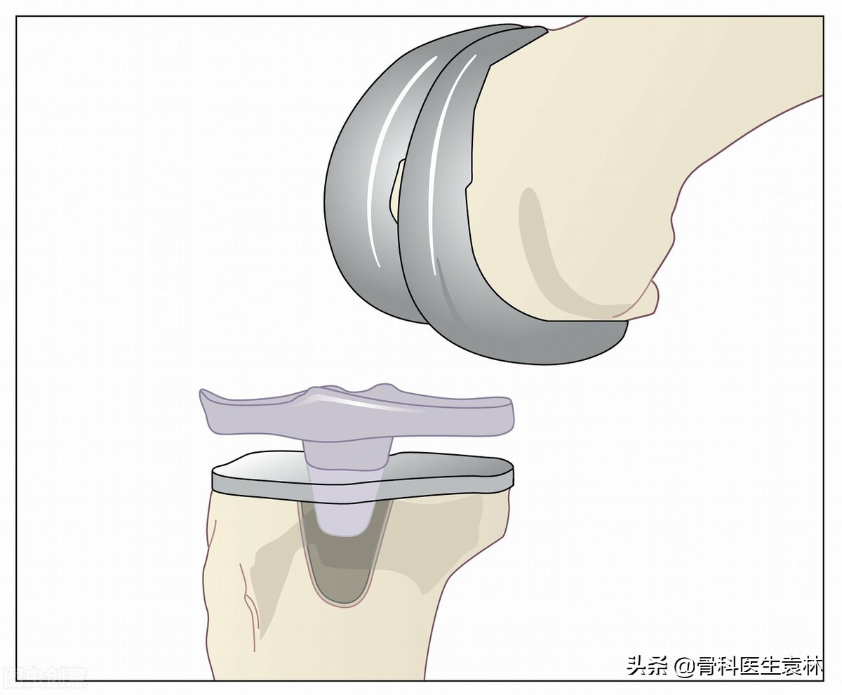膝关节置换60天走路是什么效果,膝关节置换术后康复训练