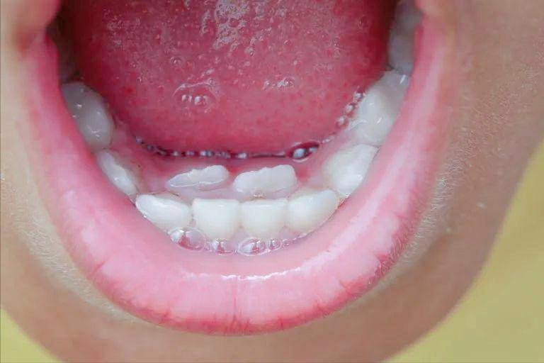 孩子有双排牙,小孩长双排牙前面的乳牙很松没掉