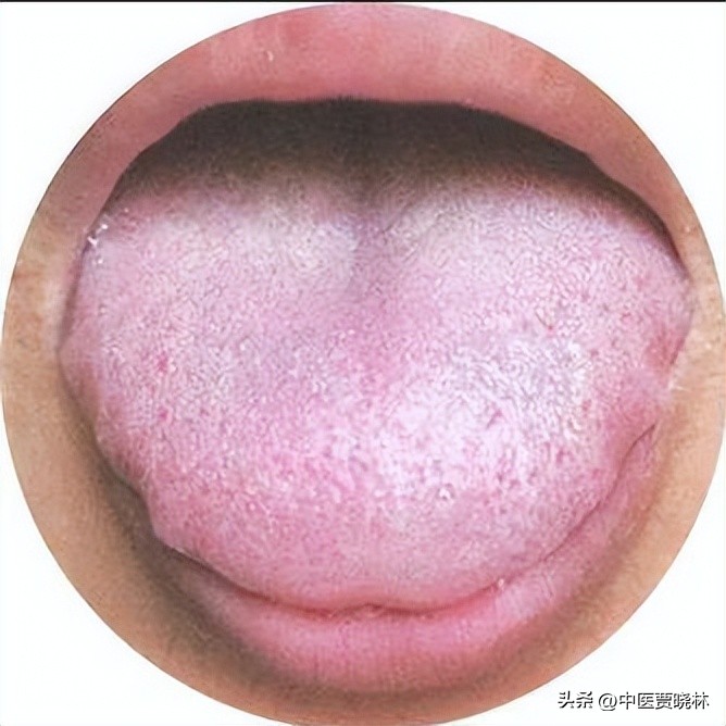 舌有齿痕属于哪一种湿气,舌边有齿痕一定是体内湿气吗