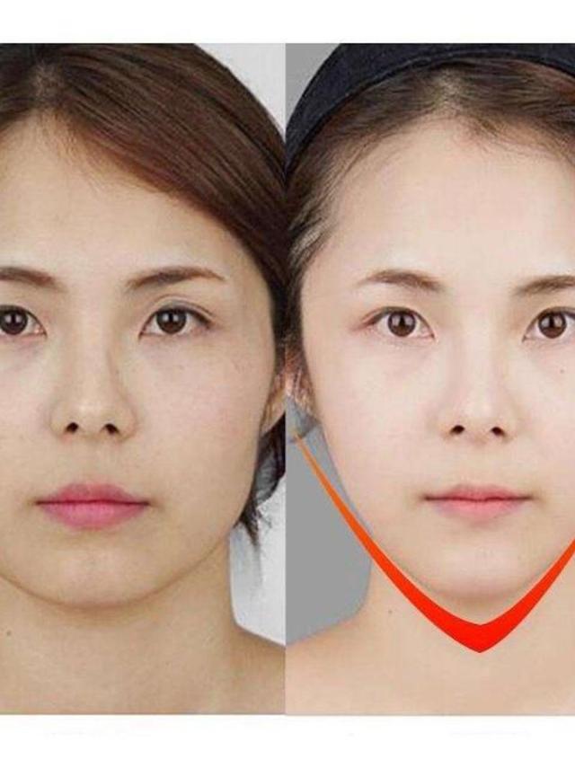 咬肌大反复打瘦脸针还是一直大,打瘦脸针第三天咬肌仍然有力