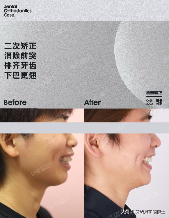 早期矫正下颌往前伸怎么纠正,改善正畸后锁颌方法