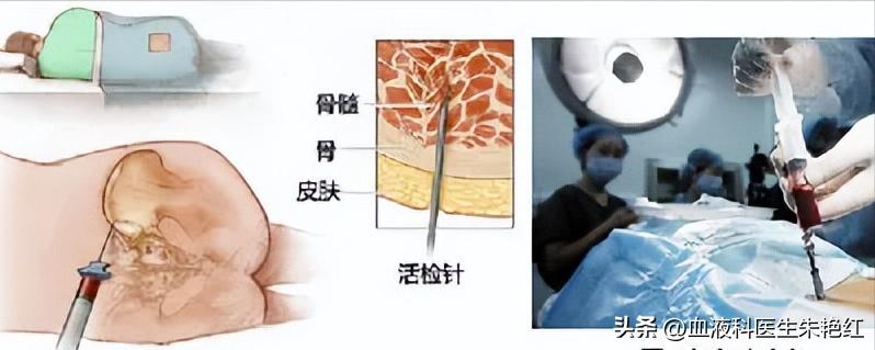 孩子再生障碍性贫血血常规指标,再生障碍性贫血是要检查血常规吗