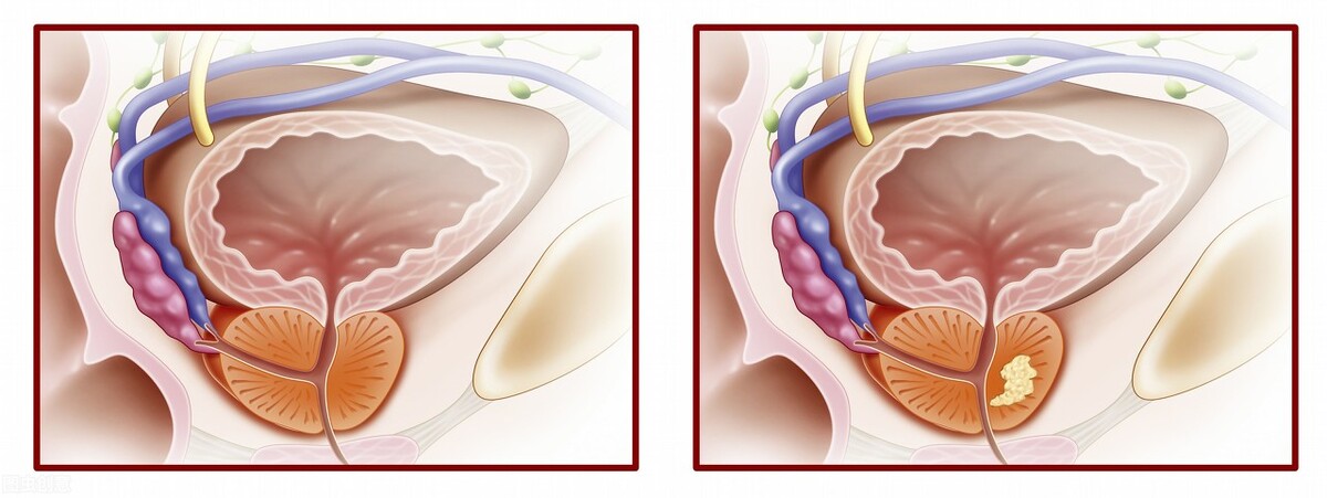 为啥慢性炎症比急性炎症难治,慢性炎症为什么难治