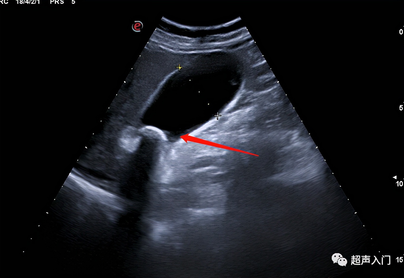 超声学自己能学吗,超声初学者有何窍门