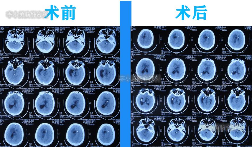 脑积水三脑室造瘘多久能恢复,脑囊虫手术后脑积水