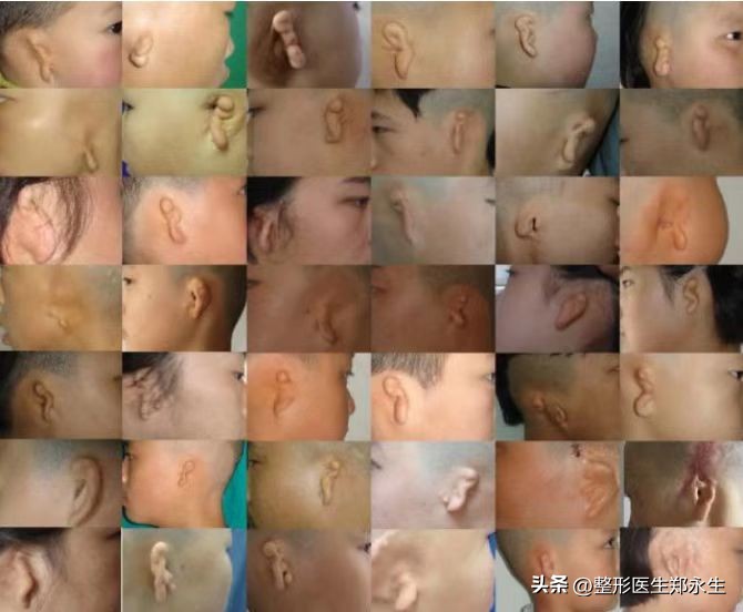 为什么会导致小耳畸形,大小耳畸形有遗传吗