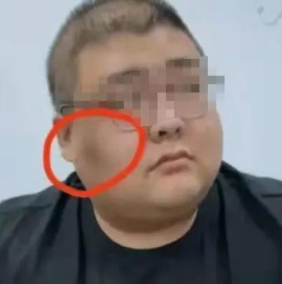 胖子脸黑斑,胖子脖子有黑斑是怎么回事