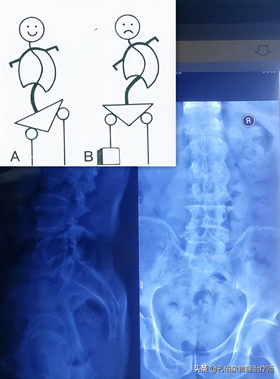 从臀部到小腿麻木疼痛怎么回事,臀部小腿酸胀是怎么回事