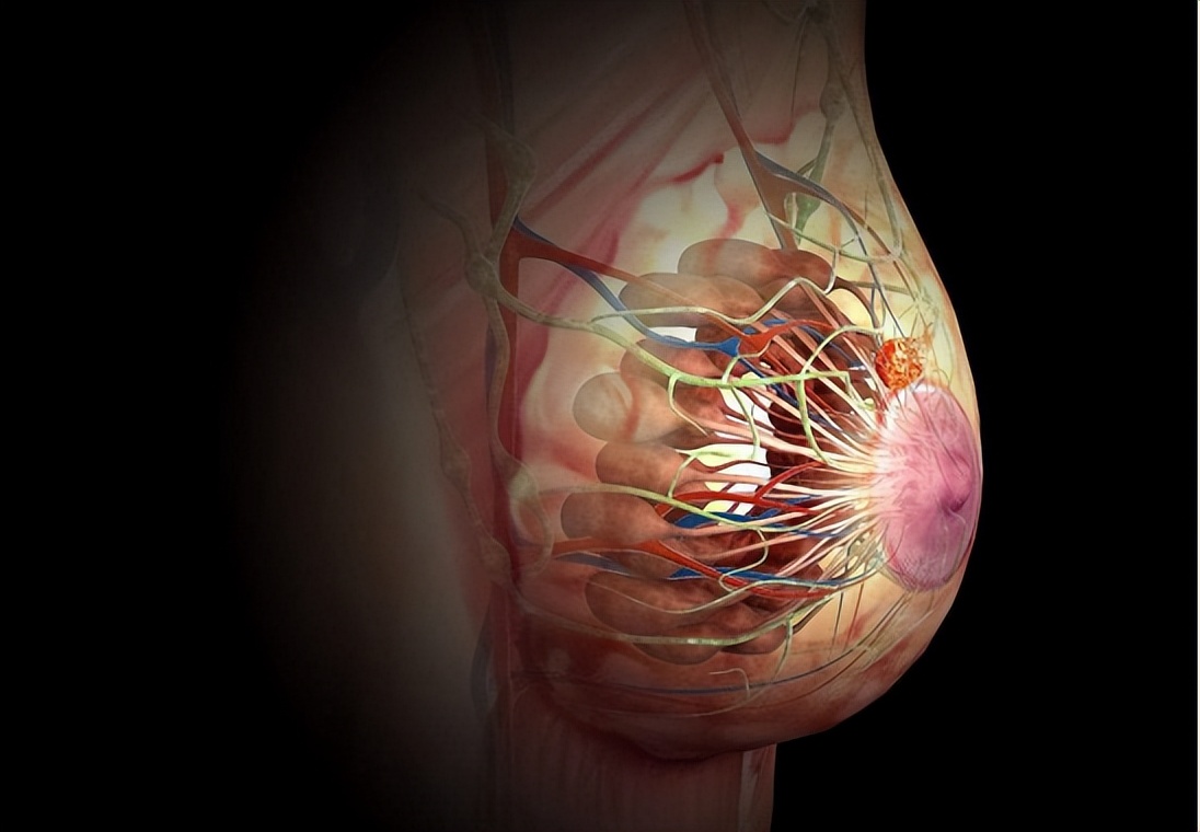 异时性双侧原发性乳腺癌10年,双侧原发性乳腺癌需要化疗吗