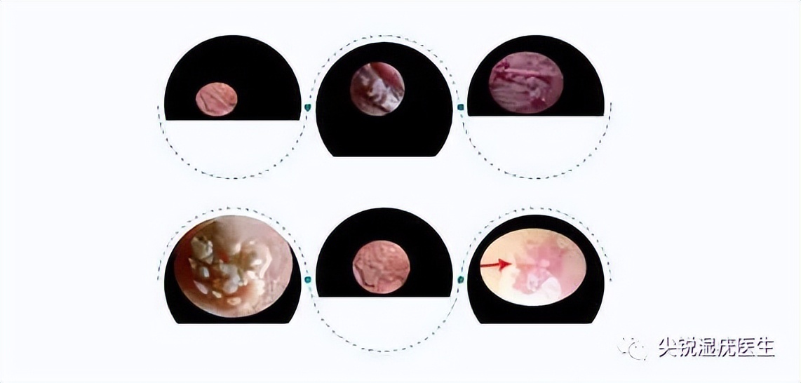 女外阴有些小疙瘩,女外阴有个小疙瘩怎么回事