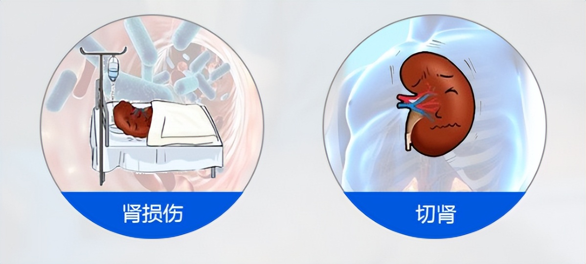 20年拖延不治双肾布满结石长成“珊瑚”！肾脏的通道被满满塞住