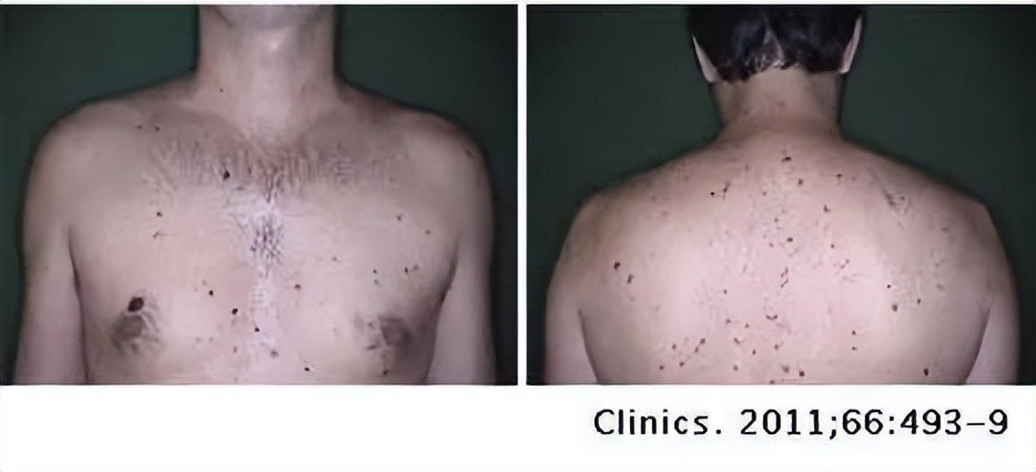 痣变黑变大是癌变了还是癌前病变,痣的病变到癌需要多长时间