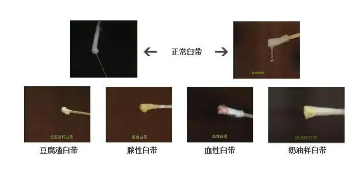 白带异常外阴瘙痒用什么药效果好,白带异常引起的外阴瘙痒用什么药