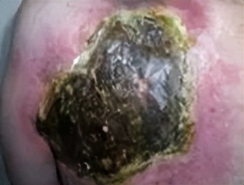 放疗皮肤护理健康宣教,放疗患者皮肤反应分类和护理