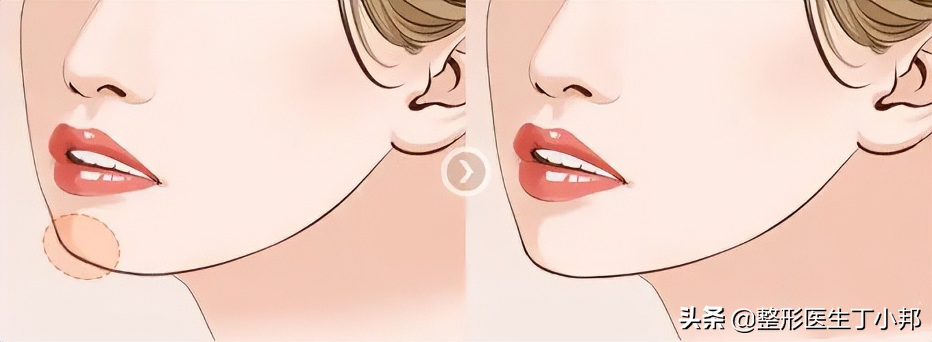 注射生长因子丰下巴导致下巴变形，怎么办？