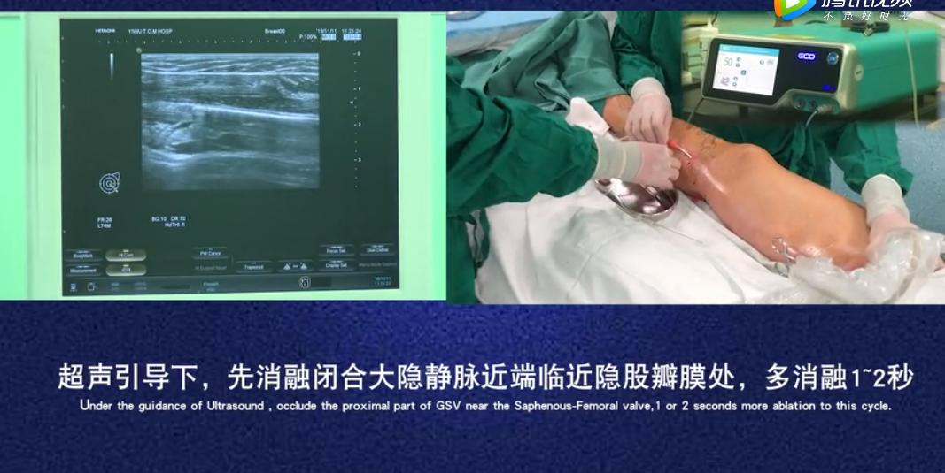 静脉曲张的福音！下肢静脉腔内微波消融闭合术，效果到底怎么样？