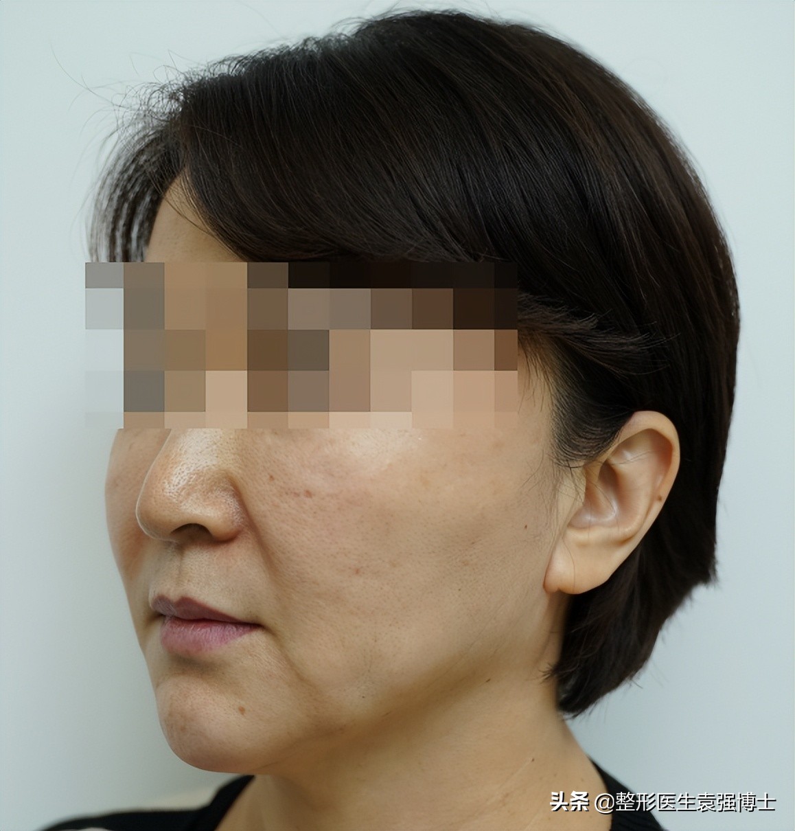 拉皮手术是额头切口还是耳前切口,拉皮手术耳前切