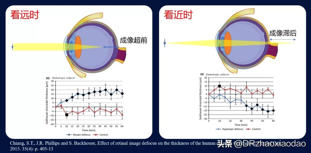 还有人以为脉络膜增厚是坏事吗？看完这篇再说吧