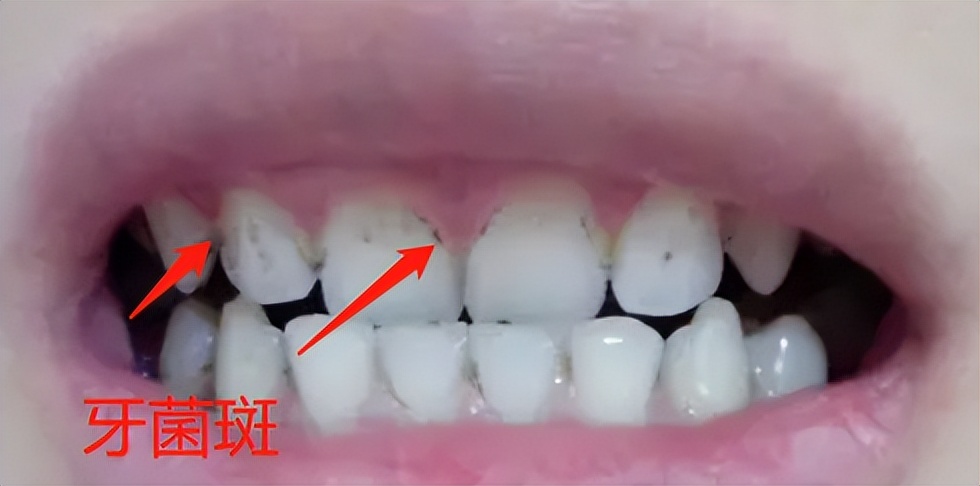 儿童如何预防蛀牙？谨防16个危害误区