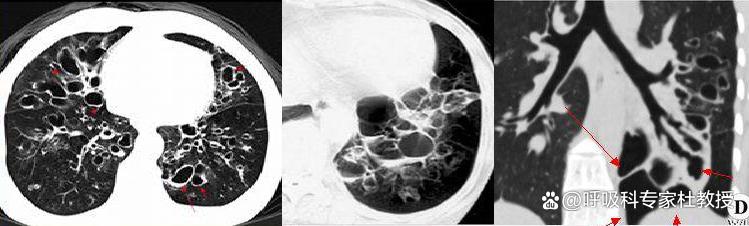 1分钟教你看懂ct报告单,一分钟自测支气管炎