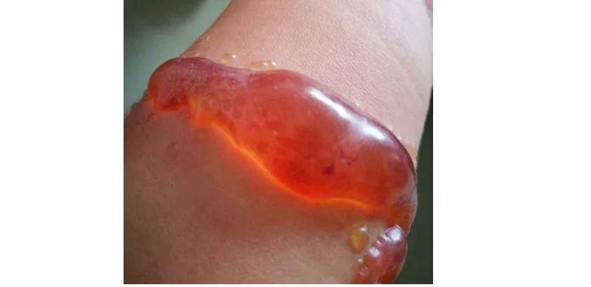 洗纹身真的不是一般人能承受的,洗纹身真的要下很大的决心