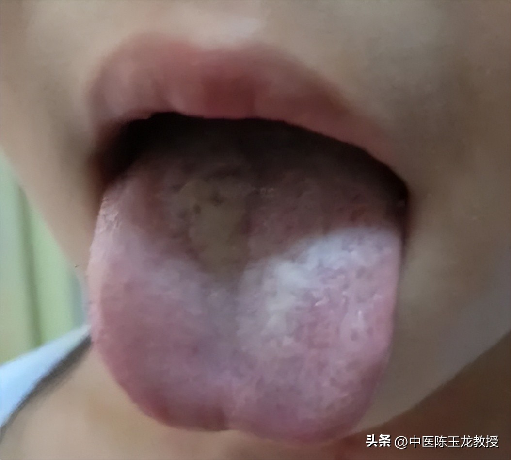 小儿腺样体肥大中医最佳治疗方法,老中医看儿童腺样体肥大怎么治疗